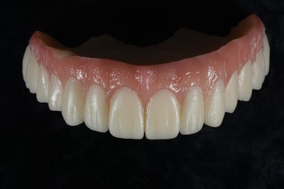 Akrylharpiks midlertidig krone