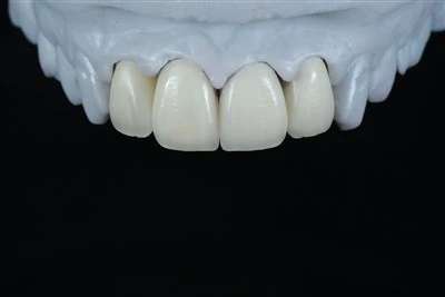 Fire-Unit Maxillary Anterior E.max Layering Finer