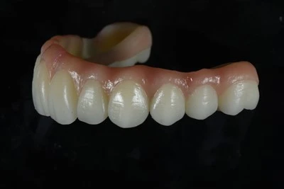 Implantat-Støttes Full-Arch Zirconia Bridge