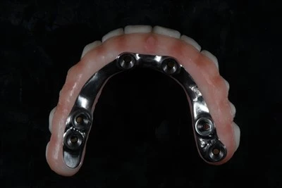 Skru-beholdt alt-på-X Zirconia Bridge