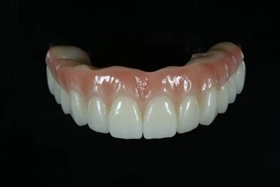 Titan-forsterket alt-på-X Zirconia Bridge